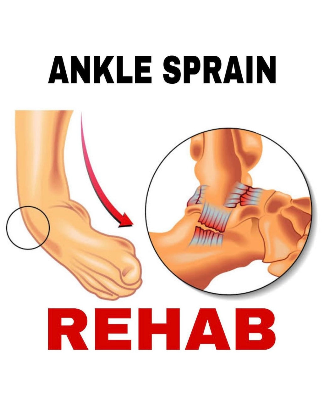 Sprained Ankle: Rehabilitation Exercises